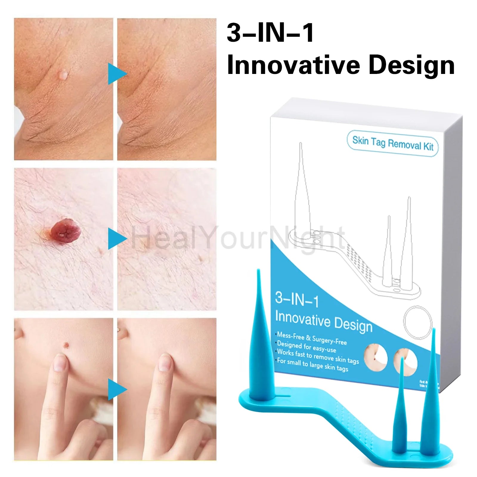 3-IN-1 Painless Skin Tag Removal Kit | Skin Label, Mole, Acne & Wart Removal Pen Set with Cleansing Swabs